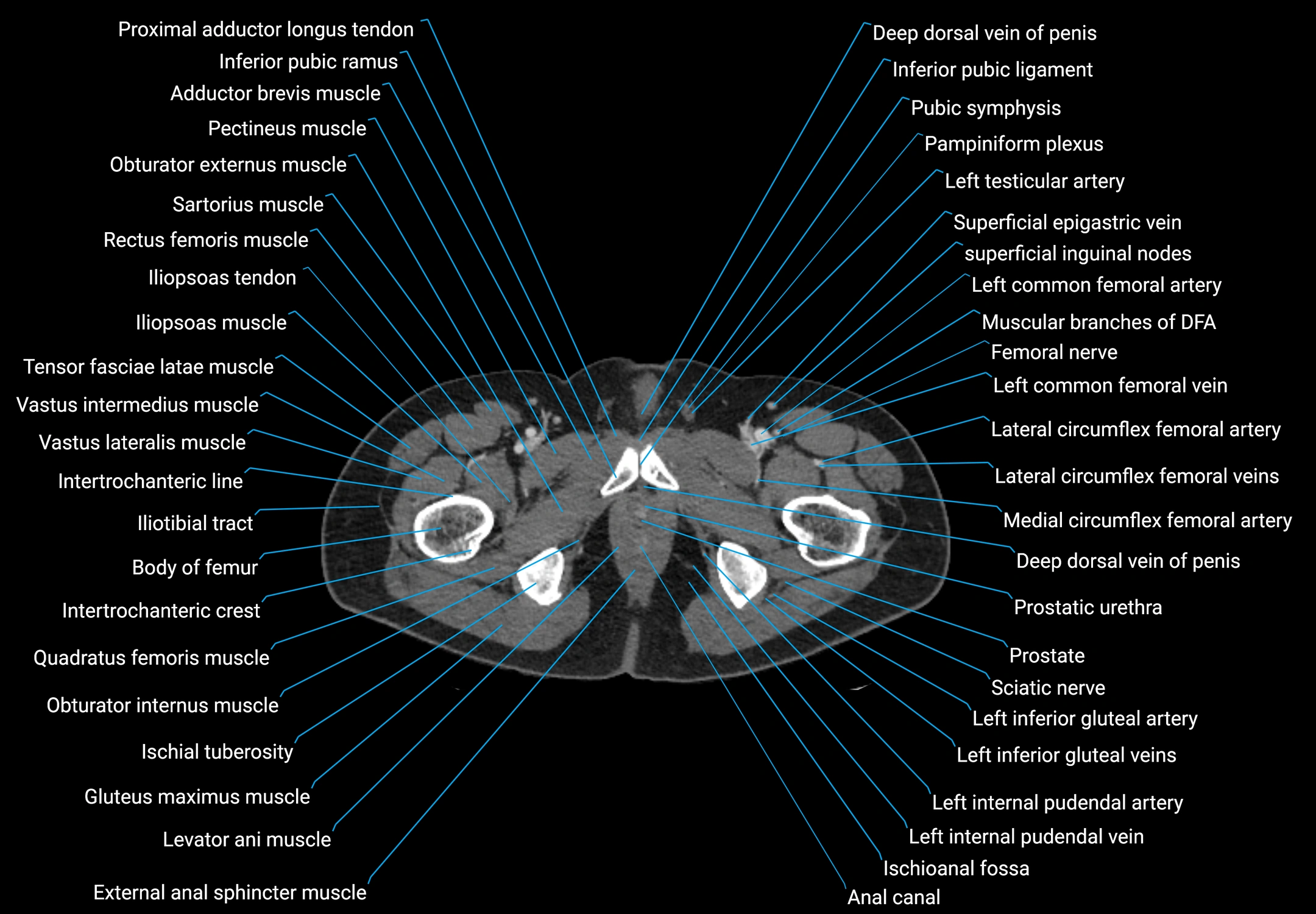 CT male pelvis axial cross sectional anatomy labelled radiology image -00206.webp